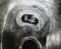 Перенос эмбрионов при ЭКО: особенности и ощущения после процедуры