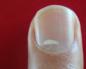 Белые пятна на ногтях пальцев рук — причины появления, что они означают?